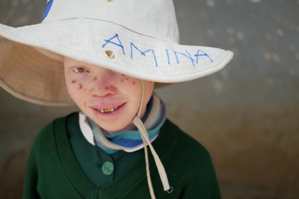 albinism Martha Mganga 5 1